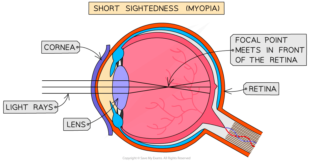 Short sightedness 1