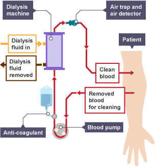 How the dialysis works